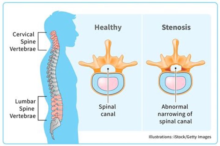 Can scoliosis cause spinal stenosis?