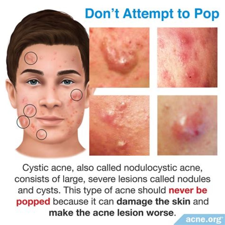 Can you put makeup on cystic acne?