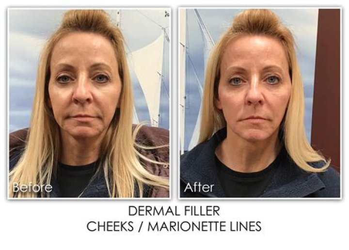 Does AngelLift work on marionette lines?
