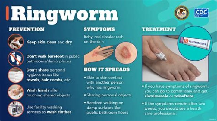 Is ringworm a fungus?