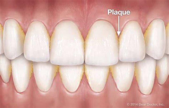 What causes plaque build up on your teeth?