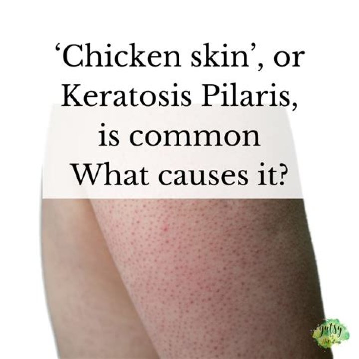 What is chicken skin rash?