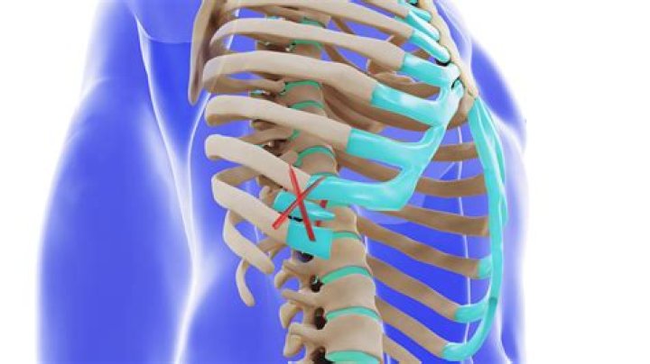 What is subluxation of the ribs?
