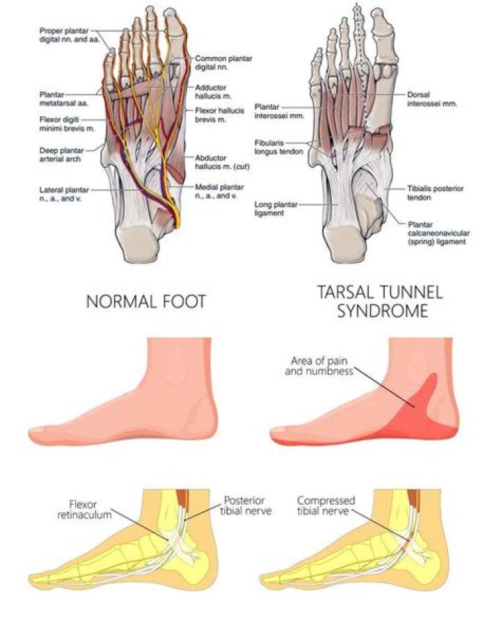 Why is my left foot numb?